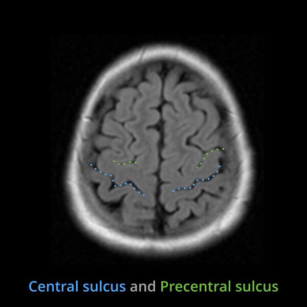 File:Anatomy- sulci of the brain (Radiopaedia 33834-34995 Central sulcus 4).jpg