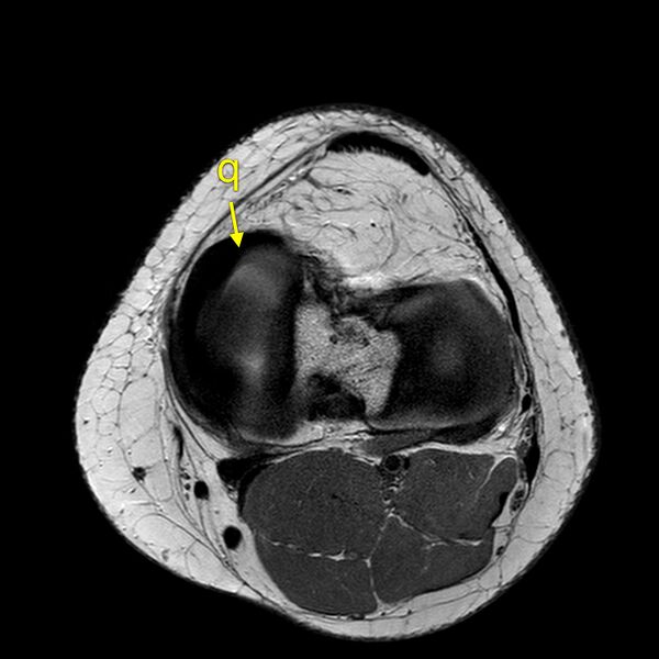 File:Anatomy Quiz (MRI knee) (Radiopaedia 43478-46866 A 18).jpeg