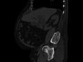 Ankylosing spondylitis (Radiopaedia 44609-48357 Sagittal bone window 33).jpg