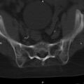 Ankylosing spondylitis (Radiopaedia 8748-9556 Axial bone window 51).jpg