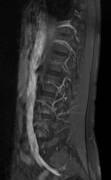 File:Ankylosing spondylitis - Andersson lesion (Radiopaedia 81878-95838 F 3).jpg