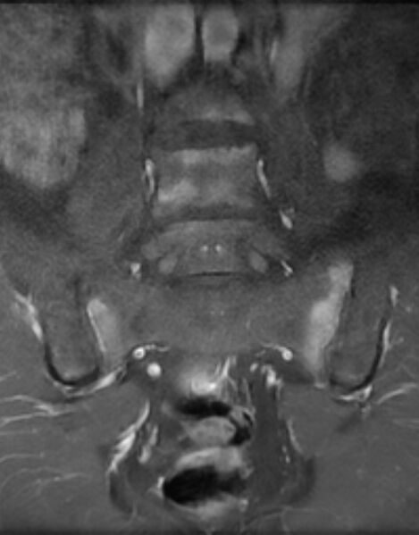 File:Ankylosing spondylitis - Andersson lesion (Radiopaedia 81878-95838 H 6).jpg