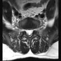 Ankylosing spondylitis with zygapophyseal arthritis (Radiopaedia 38433-40516 Axial T2 2).jpg