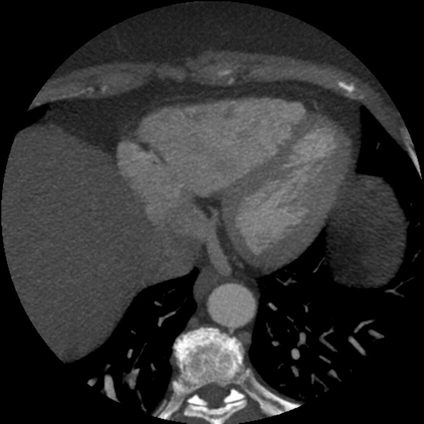 Anomalous origin of left circumflex artery from right coronary sinus (Radiopaedia 72563-83117 A 12).jpg
