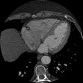 Anomalous origin of left circumflex artery from right coronary sinus (Radiopaedia 72563-83117 B 124).jpg
