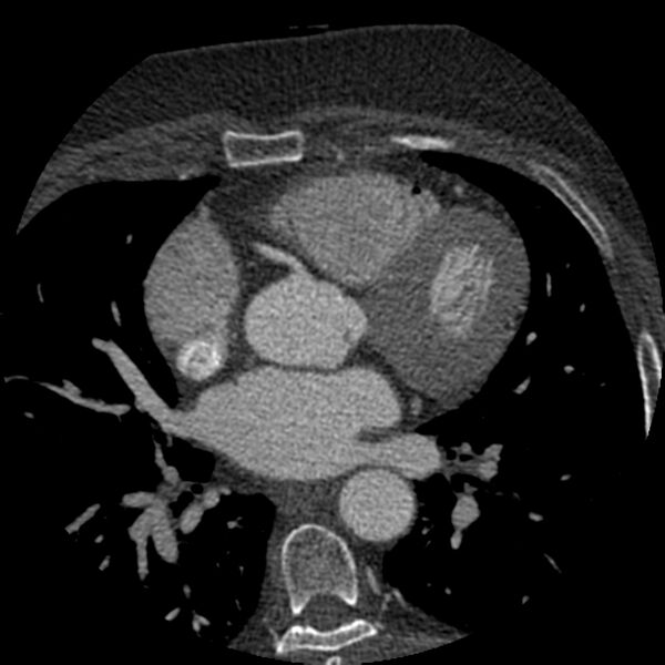 File:Anomalous origin of left circumflex artery from right coronary sinus (Radiopaedia 72563-83117 B 57).jpg