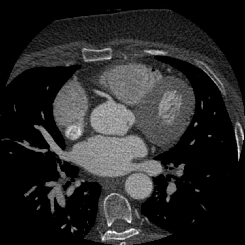 Anomalous origin of left circumflex artery from right coronary sinus (Radiopaedia 72563-83117 B 57).jpg