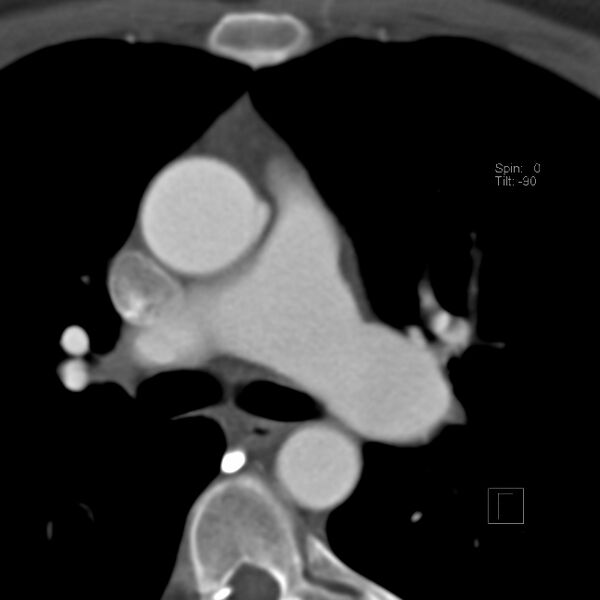 File:Anomalous right coronary artery (ARCA) with interarterial course (Radiopaedia 12423-12677 B 17).jpg