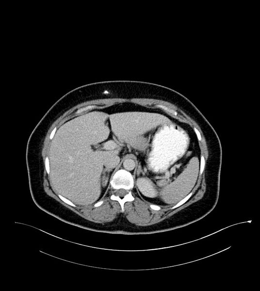 File:Anterior abdominal wall CSF pseudocyst (CSFoma) (Radiopaedia 79453-92571 A 27).jpg