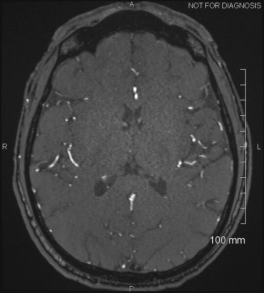File:Anterior cerebral artery aneurysm (Radiopaedia 80683-94127 Axial MRA 138).jpg