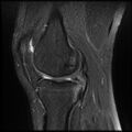 Anterior cruciate ligament tear with posteromedial corner injury, bucket-handle meniscal tear and chondral delamination (Radiopaedia 75501-86744 Sagittal PD fat sat 10).jpg