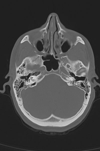 File:Anterior nasal spine fracture (Radiopaedia 46138-50494 Axial bone window 44).png
