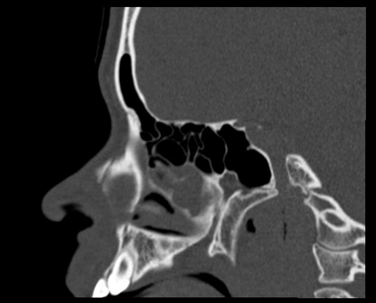 File:Antrochoanal polyp (Radiopaedia 21894-21868 Sagittal bone window 15).jpg