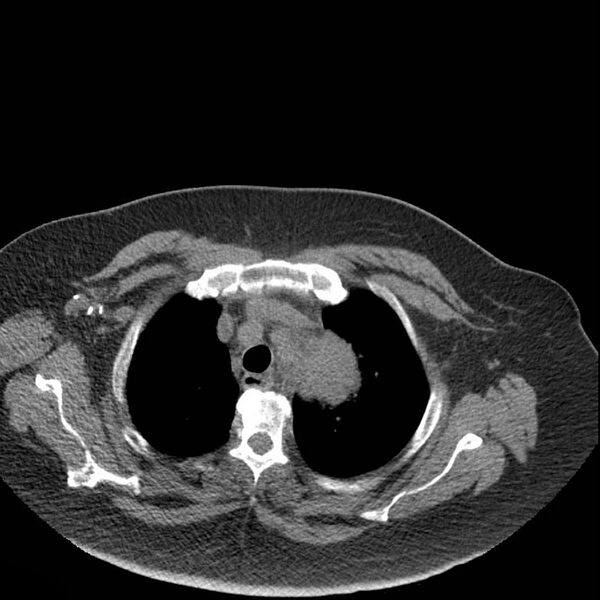 File:Aortic arch false aneurysm (Radiopaedia 14667-14587 Axial non-contrast 2).jpg