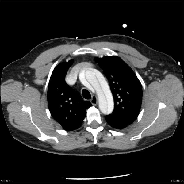 File:Aortic dissection- Stanford A (Radiopaedia 37759-39664 A 12).jpg