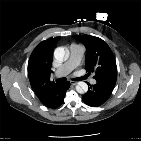 File:Aortic dissection- Stanford A (Radiopaedia 37759-39664 A 29).jpg