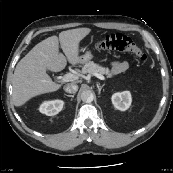 File:Aortic dissection- Stanford A (Radiopaedia 37759-39664 A 77).jpg