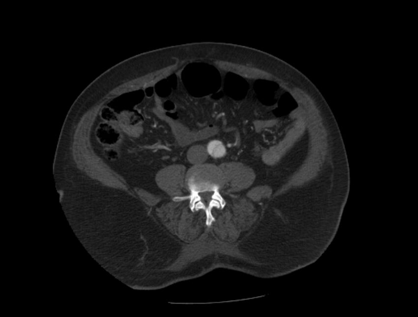 Aortic dissection (Radiopaedia 28802-29105 A 74).jpg