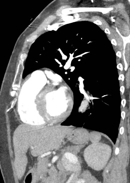 File:Aortic dissection - Stanford type B (Radiopaedia 50171-55512 C 16).png