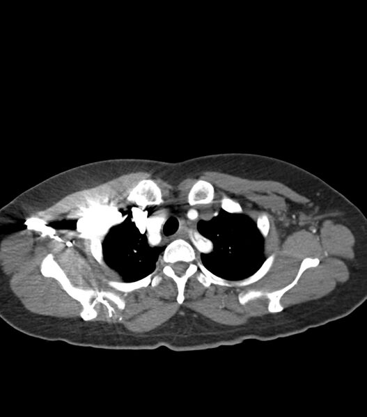 File:Aortic dissection with renal ischemia (Radiopaedia 76573-88338 A 8).jpg