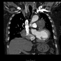 Aorto-coronary bypass graft aneurysms (Radiopaedia 40562-43157 B 19).png