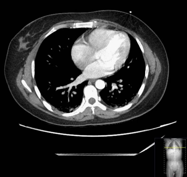 File:Appendicitis (CT angiogram) (Radiopaedia 154713-127660 Axial 189).jpg