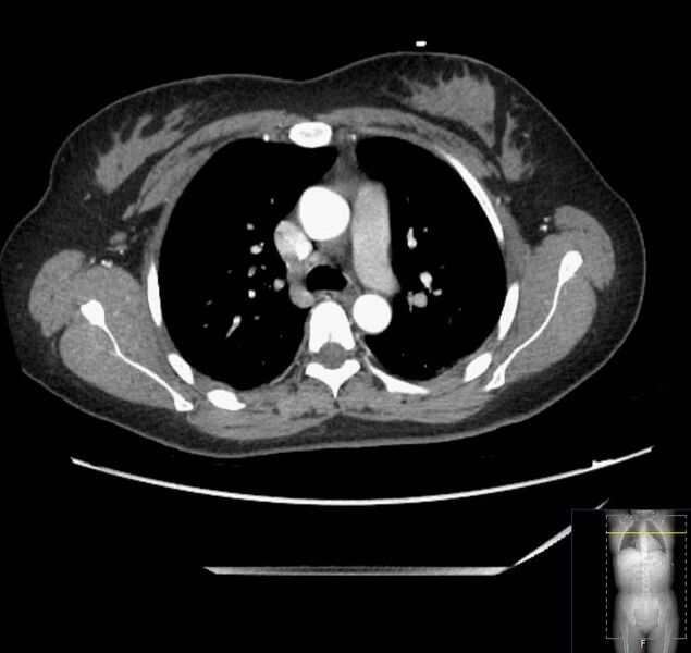 File:Appendicitis (CT angiogram) (Radiopaedia 154713-127660 Axial 212).jpg