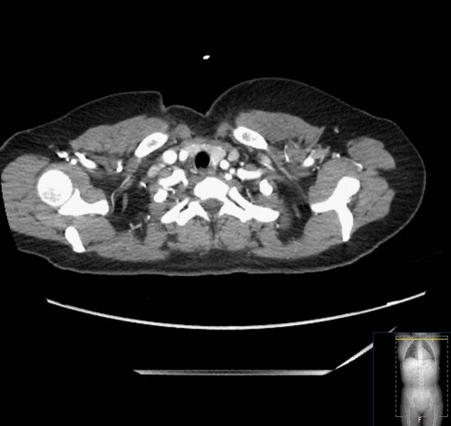 File:Appendicitis (CT angiogram) (Radiopaedia 154713-127660 Axial 238).jpg