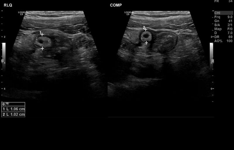File:Appendicitis and incidental foregut duplication cyst (Radiopaedia 52962-58918 A 6).jpg