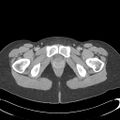 Appendicitis with minimal stranding but appendicolith (Radiopaedia 29035-29397 A 86).jpg