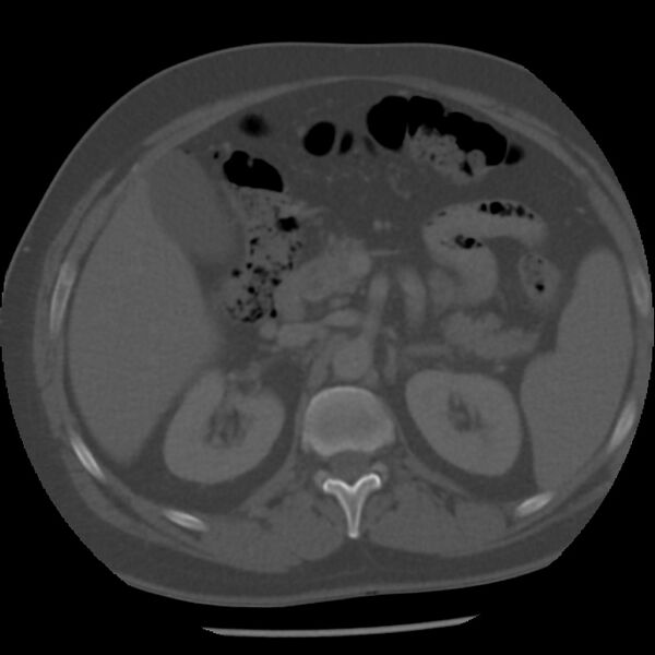File:Appendicitis with perforation (Radiopaedia 35790-37342 Axial bone window 17).jpg