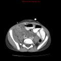 Appendicitis with phlegmon (Radiopaedia 9358-10046 A 50).jpg