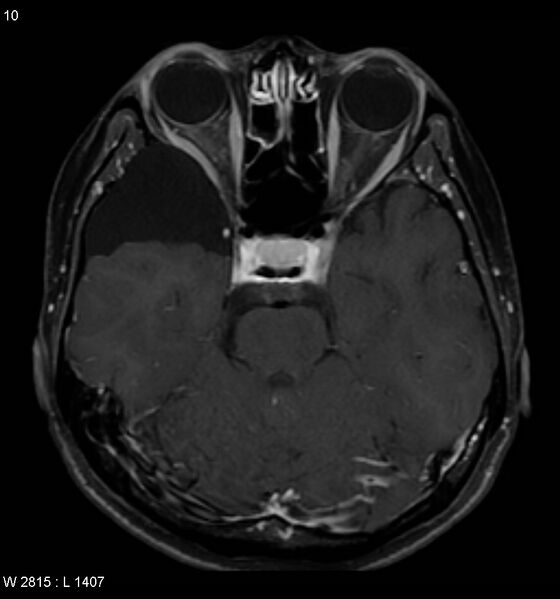 File:Arachnoid cyst - middle cranial fossa (Radiopaedia 4768-6774 Axial T1 C+ fat sat 1).jpg
