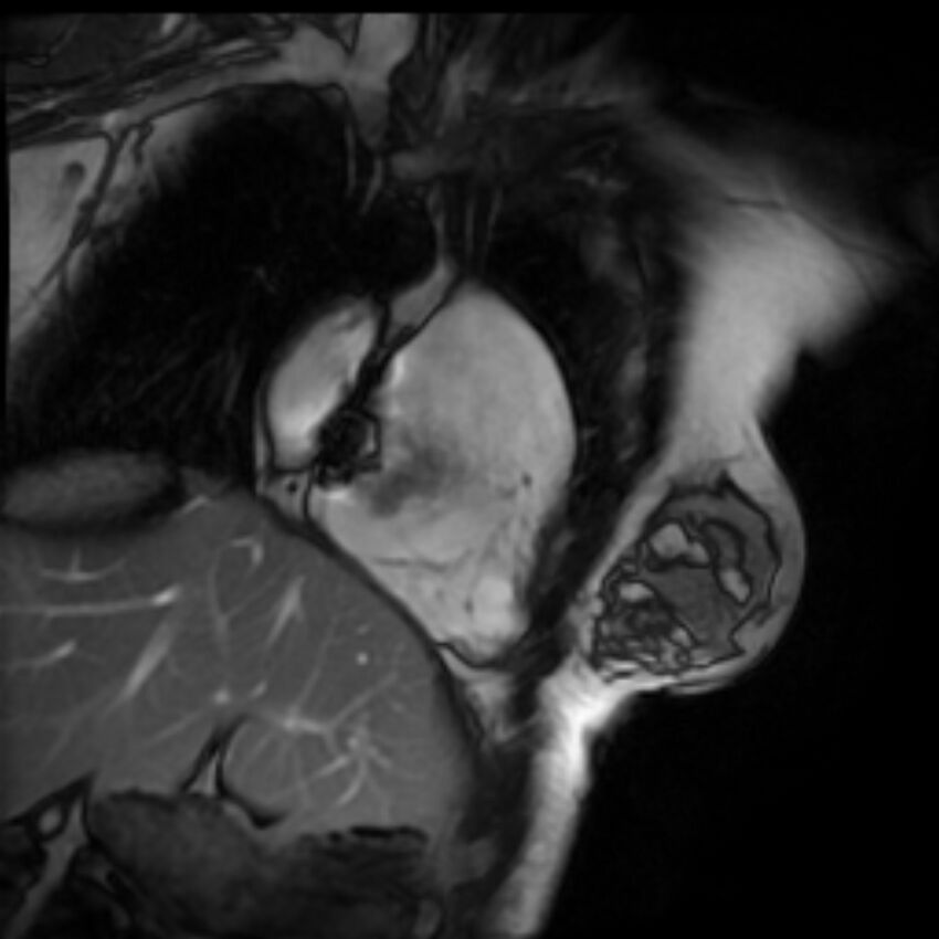 Arrhythmogenic right ventricular cardiomyopathy (Radiopaedia 87505-103850 2ch (RV) Cine SSFP 80).jpg