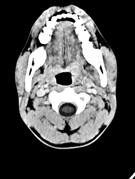 File:Arrow injury to the face (Radiopaedia 73267-84011 Axial C+ delayed 21).jpg