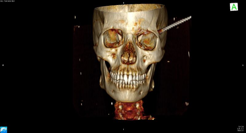 File:Arrow injury to the head (Radiopaedia 75266-86388 3D vertical 2).jpg