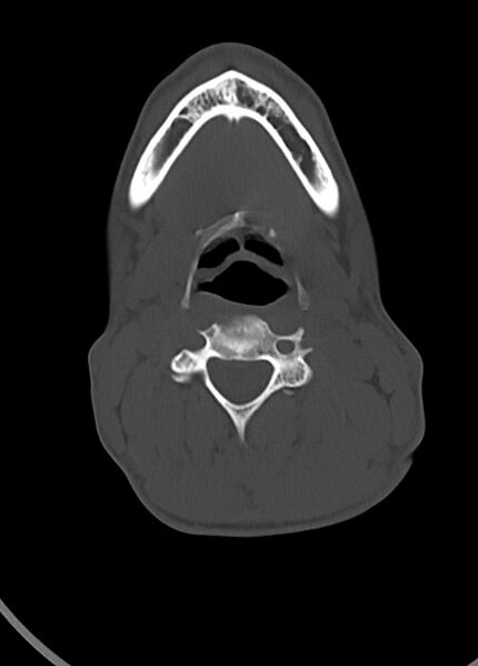 File:Arrow injury to the head (Radiopaedia 75266-86388 Axial bone window 14).jpg