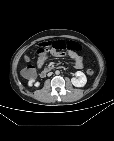 File:Arterial occlusive mesenteric ischemia (Radiopaedia 84641-100054 A 52).jpg