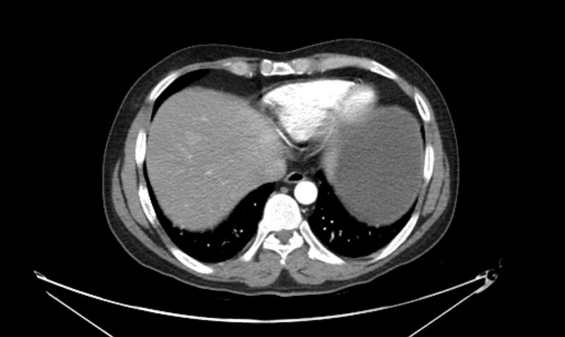 File:Arterial occlusive mesenteric ischemia (Radiopaedia 84641-100060 A 18).jpg