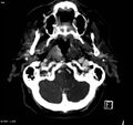 Arteriovenous malformation - cerebral (Radiopaedia 8172-14682 A 1).jpg