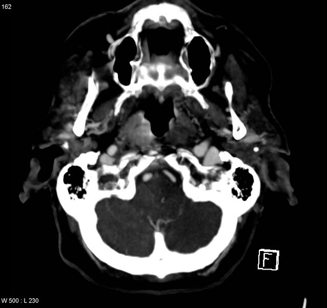 File:Arteriovenous malformation - cerebral (Radiopaedia 8172-14682 A 1).jpg