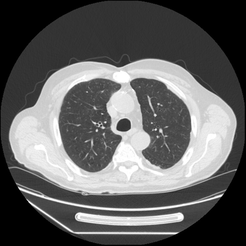 Asbestosis complicated by lung cancer (Radiopaedia 45834-50116 Axial lung window 22).jpg
