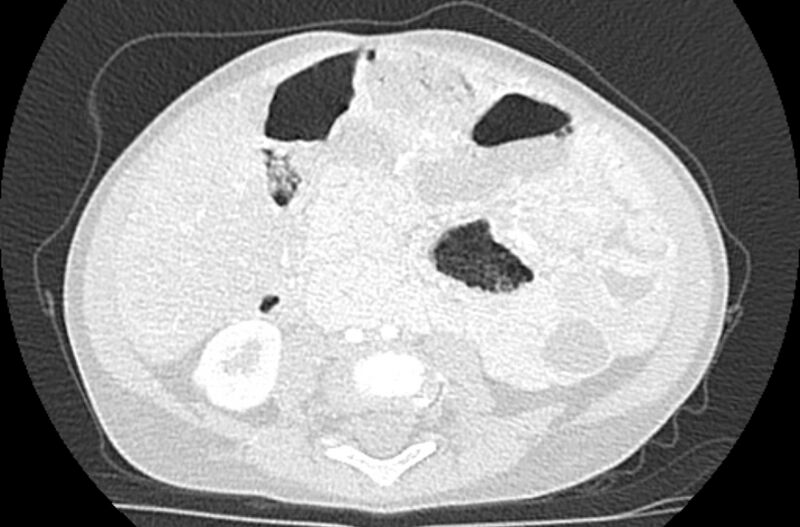 File:Asplenia syndrome (Radiopaedia 73083-83792 Axial lung window 107).jpg