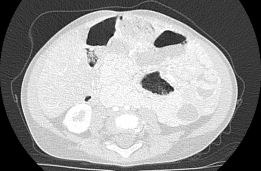 Asplenia syndrome (Radiopaedia 73083-83792 Axial lung window 107).jpg