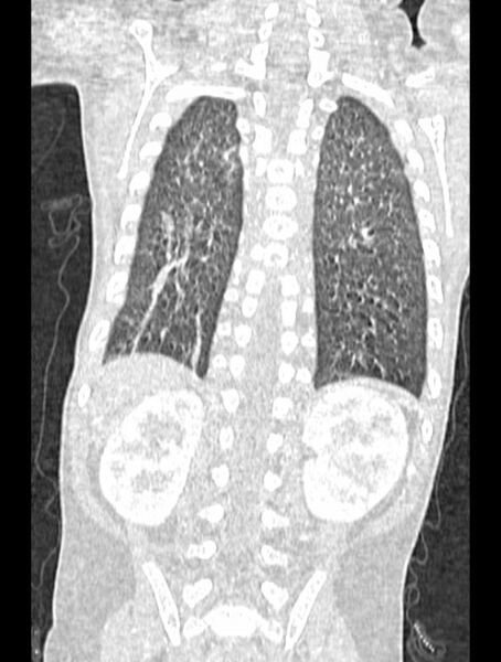 File:Asplenia syndrome (Radiopaedia 73083-83792 Coronal lung window 111).jpg