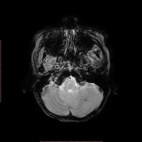 File:Astroblastoma (Radiopaedia 74287-85162 Axial SWI 3).jpg