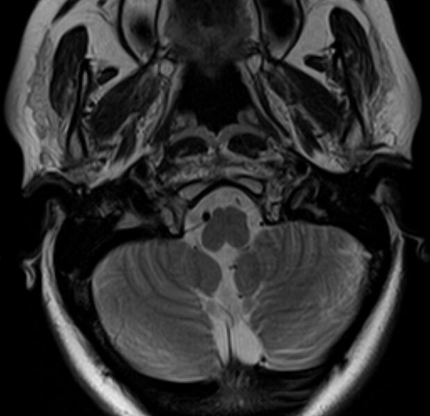 File:Astrocytoma - spinal cord (Radiopaedia 69769-79758 Axial T2 2).jpg