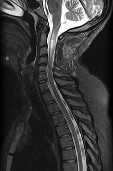 File:Astrocytoma - spinal cord (Radiopaedia 69769-79758 Sagittal STIR 7).jpg