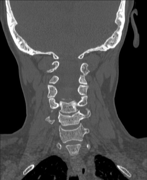 File:Atlanto-occipital assimilation with basilar invagination (Radiopaedia 70122-80188 Coronal bone window 124).jpg