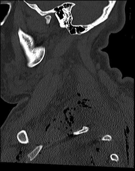 File:Atlanto-occipital dissociation - Traynelis type 1 (Radiopaedia 87570-103948 Sagittal bone window 23).jpg